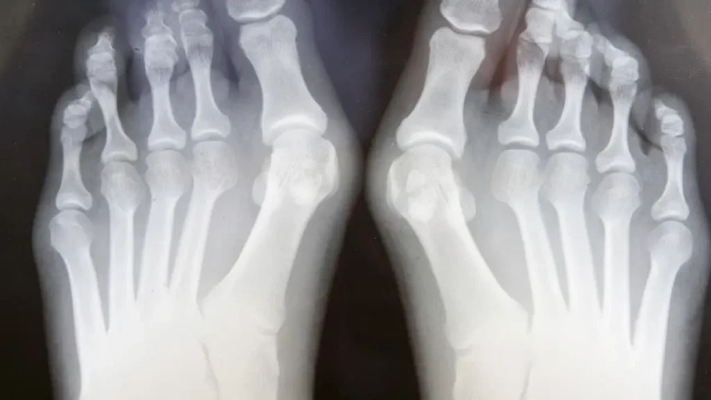 Quantos dias de atestado para cirurgia de joanete